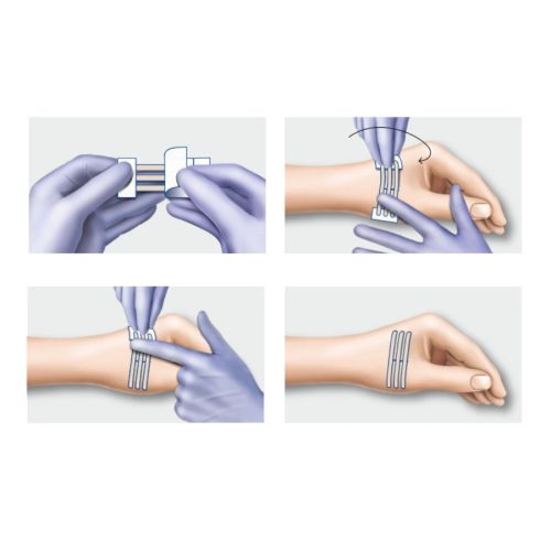 Omnistrip wound strip box
